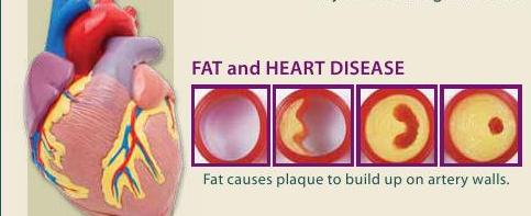 Artery blockage and Heart disease pictures